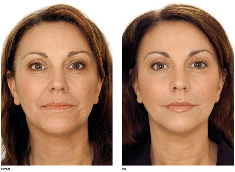 Nie tylko botox...